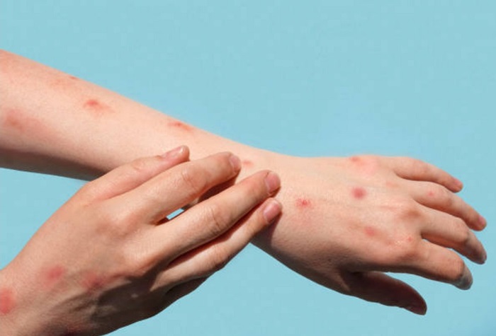 Juazeiro notifica segundo caso suspeito de Monkeypox (Varíola dos Macacos)