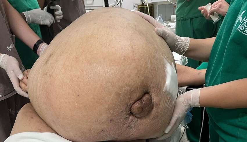 Morre mulher que retirou tumor de 46 kg em cirurgia de emergência
