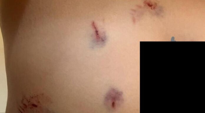 Criança é atacada por cães em um condomínio no bairro Pedra do Lorde, em Juazeiro, e moradores cobram adoção de políticas efetivas de controle populacional dos animais