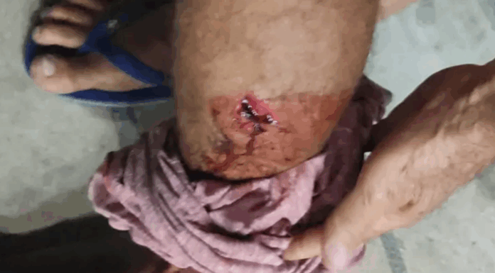 Homem é agredido com pé de cabra durante tentativa de cobrança de dívida