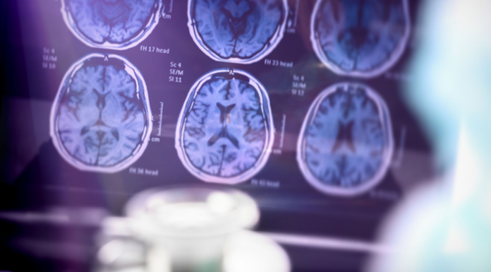 Alzheimer: caso de Fernando Henrique Cardoso chama atenção para os desafios da doença que afeta milhões de idosos